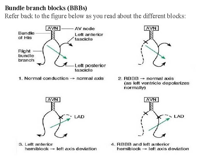 Bundle branch blocks (BBBs) Refer back to the figure below as you read about Bundle branch blocks (BBBs) Refer back to the figure below as you read about