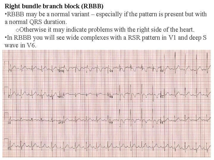 Right bundle branch block (RBBB) • RBBB may be a normal variant – especially Right bundle branch block (RBBB) • RBBB may be a normal variant – especially