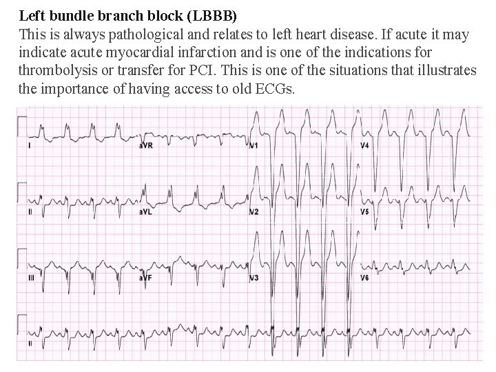 Left bundle branch block (LBBB) This is always pathological and relates to left heart Left bundle branch block (LBBB) This is always pathological and relates to left heart