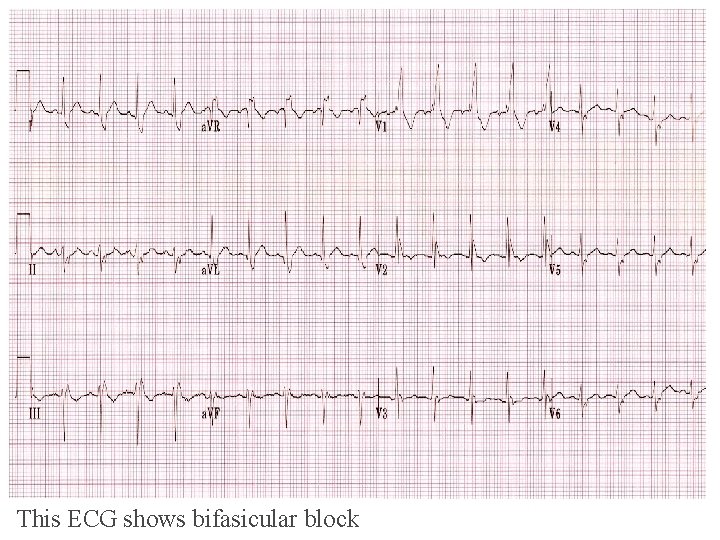 This ECG shows bifasicular block This ECG shows bifasicular block