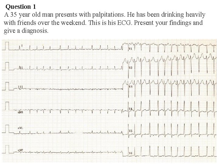 Question 1 A 35 year old man presents with palpitations. He has been Question 1 A 35 year old man presents with palpitations. He has been