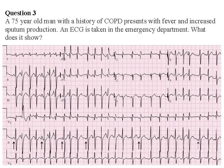 Question 3 A 75 year old man with a history of COPD presents with Question 3 A 75 year old man with a history of COPD presents with