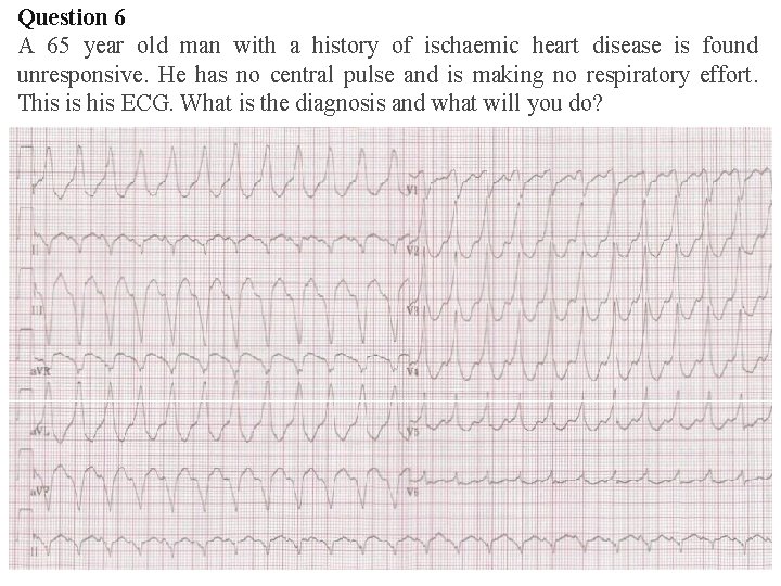 Question 6 A 65 year old man with a history of ischaemic heart disease Question 6 A 65 year old man with a history of ischaemic heart disease