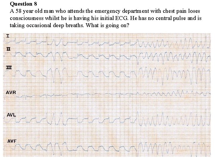 Question 8 A 58 year old man who attends the emergency department with chest Question 8 A 58 year old man who attends the emergency department with chest