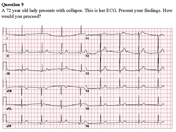 Question 9 A 72 year old lady presents with collapse. This is her ECG. Question 9 A 72 year old lady presents with collapse. This is her ECG.