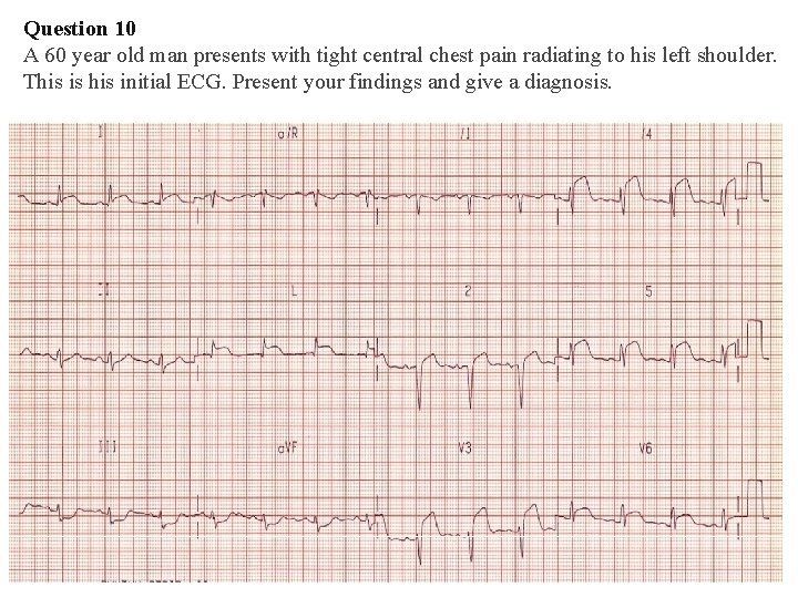 Question 10 A 60 year old man presents with tight central chest pain radiating Question 10 A 60 year old man presents with tight central chest pain radiating