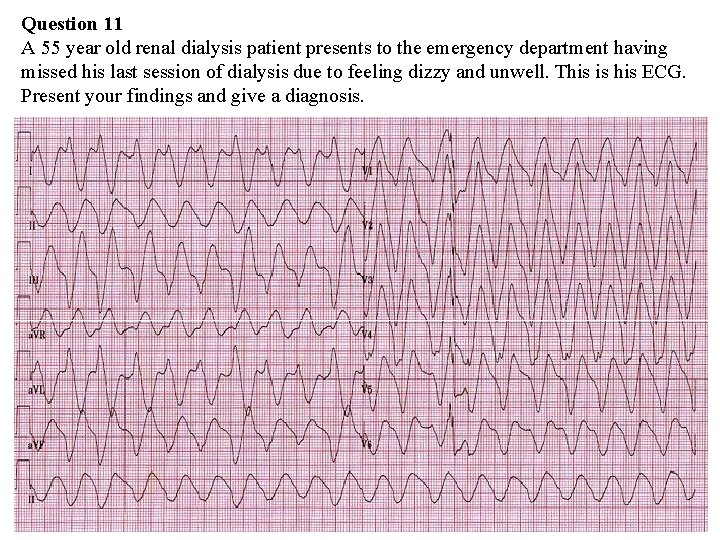 Question 11 A 55 year old renal dialysis patient presents to the emergency department Question 11 A 55 year old renal dialysis patient presents to the emergency department