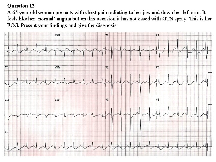 Question 12 A 65 year old woman presents with chest pain radiating to her Question 12 A 65 year old woman presents with chest pain radiating to her