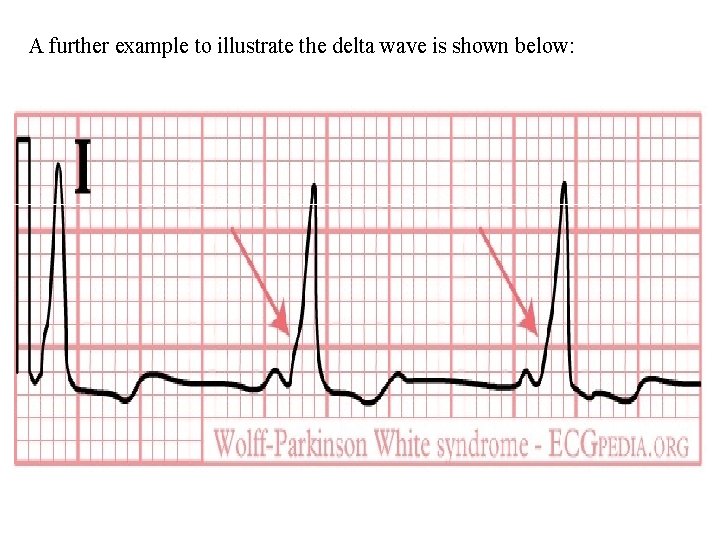 A further example to illustrate the delta wave is shown below: A further example to illustrate the delta wave is shown below: