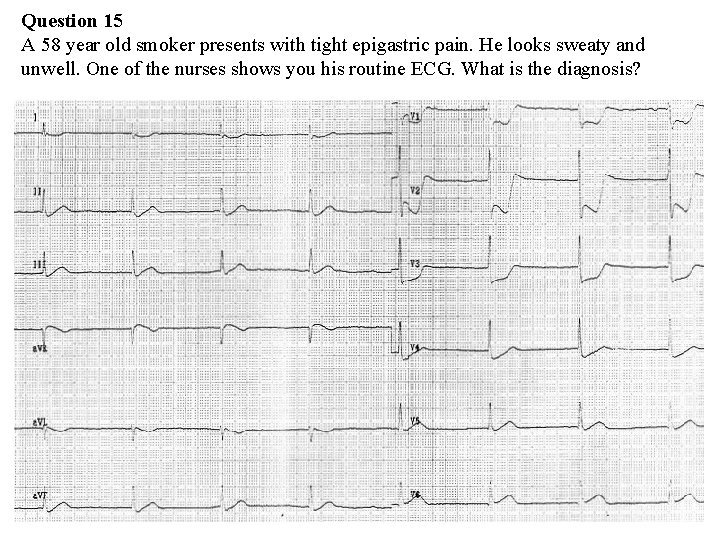 Question 15 A 58 year old smoker presents with tight epigastric pain. He looks Question 15 A 58 year old smoker presents with tight epigastric pain. He looks