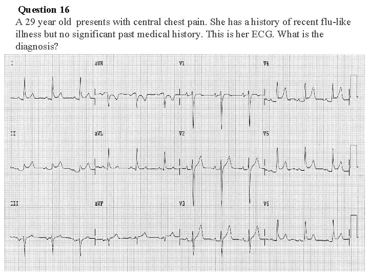 Question 16 A 29 year old presents with central chest pain. She has Question 16 A 29 year old presents with central chest pain. She has