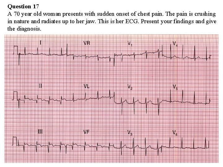 Question 17 A 70 year old woman presents with sudden onset of chest pain. Question 17 A 70 year old woman presents with sudden onset of chest pain.