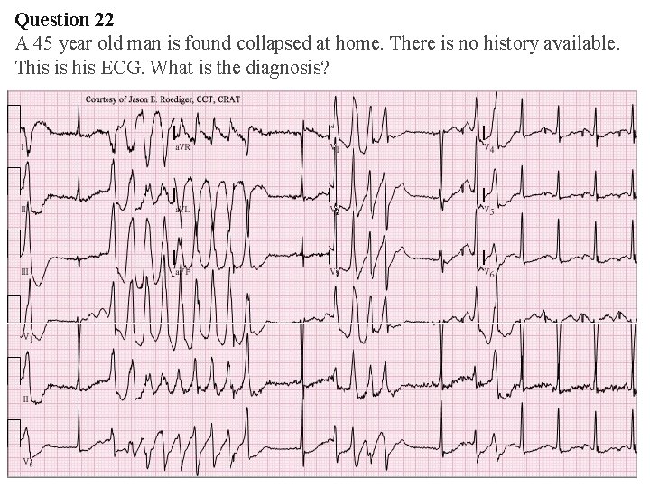 Question 22 A 45 year old man is found collapsed at home. There is Question 22 A 45 year old man is found collapsed at home. There is