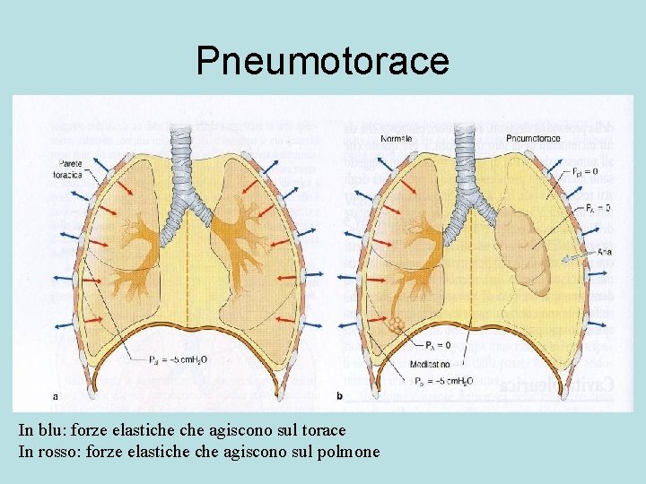 Pneumotorace In blu: forze elastiche agiscono sul torace In rosso: forze elastiche agiscono sul