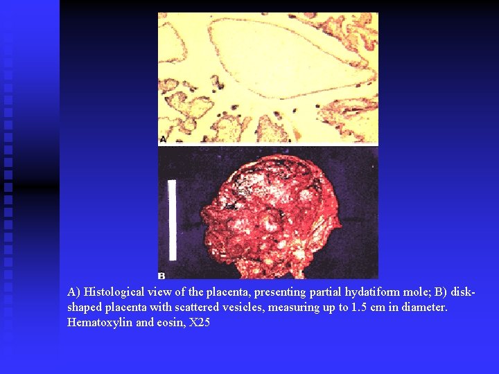 A) Histological view of the placenta, presenting partial hydatiform mole; B) diskshaped placenta with A) Histological view of the placenta, presenting partial hydatiform mole; B) diskshaped placenta with