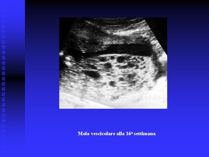 Mola vescicolare alla 16 a settimana Mola vescicolare alla 16 a settimana