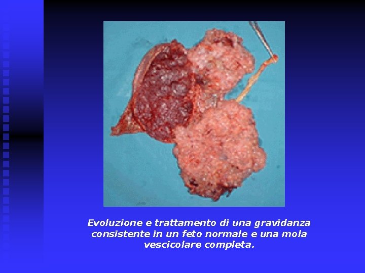Evoluzione e trattamento di una gravidanza consistente in un feto normale e una mola Evoluzione e trattamento di una gravidanza consistente in un feto normale e una mola