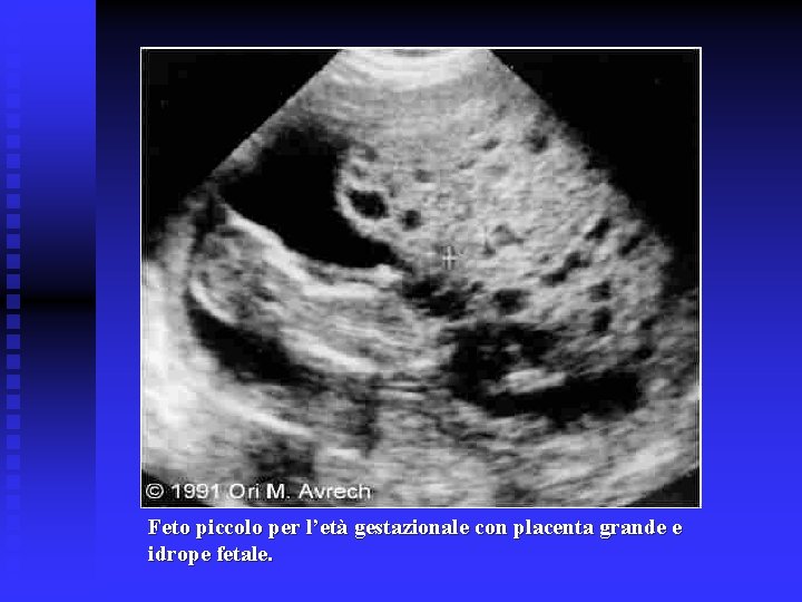 Feto piccolo per l’età gestazionale con placenta grande e idrope fetale. Feto piccolo per l’età gestazionale con placenta grande e idrope fetale.