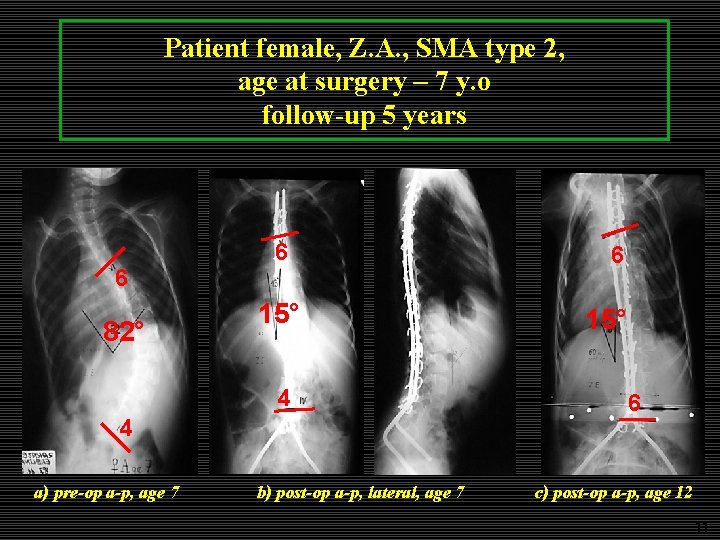 Patient female, Z. A. , SMA type 2, age at surgery – 7 y. Patient female, Z. A. , SMA type 2, age at surgery – 7 y.