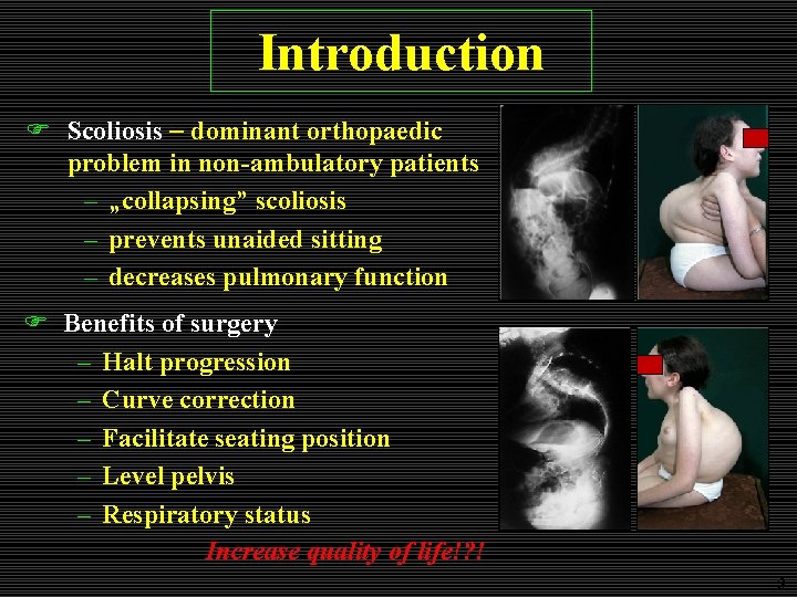 Introduction F Scoliosis dominant orthopaedic problem in non-ambulatory patients – „collapsing” scoliosis – prevents Introduction F Scoliosis dominant orthopaedic problem in non-ambulatory patients – „collapsing” scoliosis – prevents