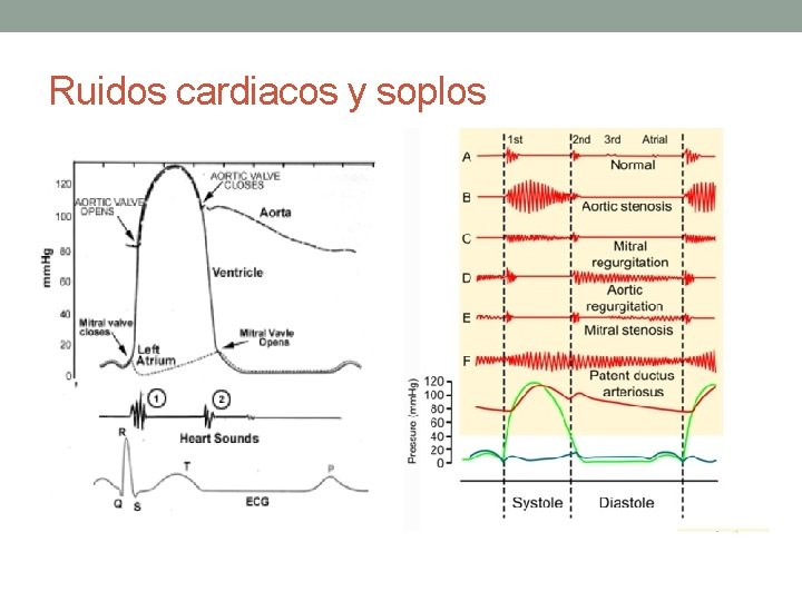 Ruidos cardiacos y soplos Ruidos cardiacos y soplos
