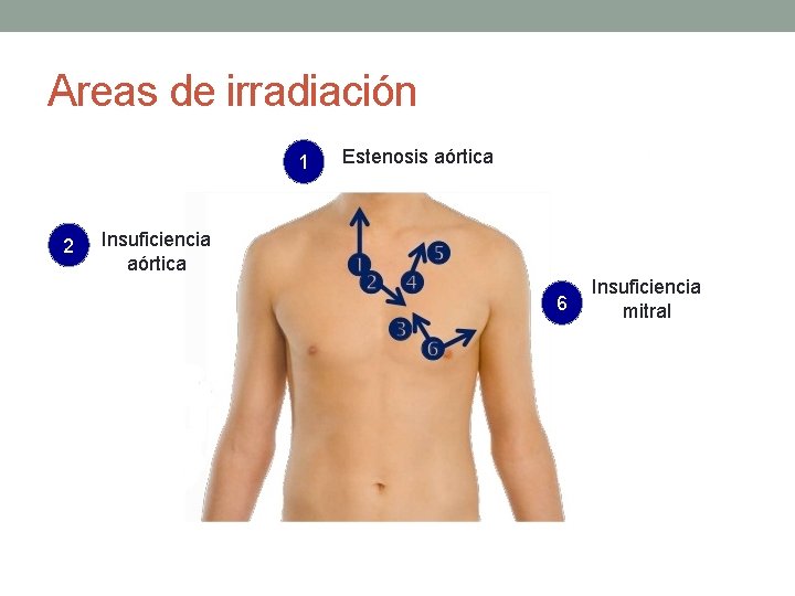 Areas de irradiación 1 2 Estenosis aórtica Insuficiencia aórtica 6 Insuficiencia mitral Areas de irradiación 1 2 Estenosis aórtica Insuficiencia aórtica 6 Insuficiencia mitral