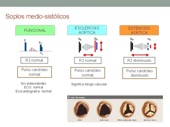 Soplos medio-sistólicos FUNCIONAL ESCLEROSIS AORTICA ESTENOSIS AORTICA R 2 normal R 2 disminuido Pulso Soplos medio-sistólicos FUNCIONAL ESCLEROSIS AORTICA ESTENOSIS AORTICA R 2 normal R 2 disminuido Pulso