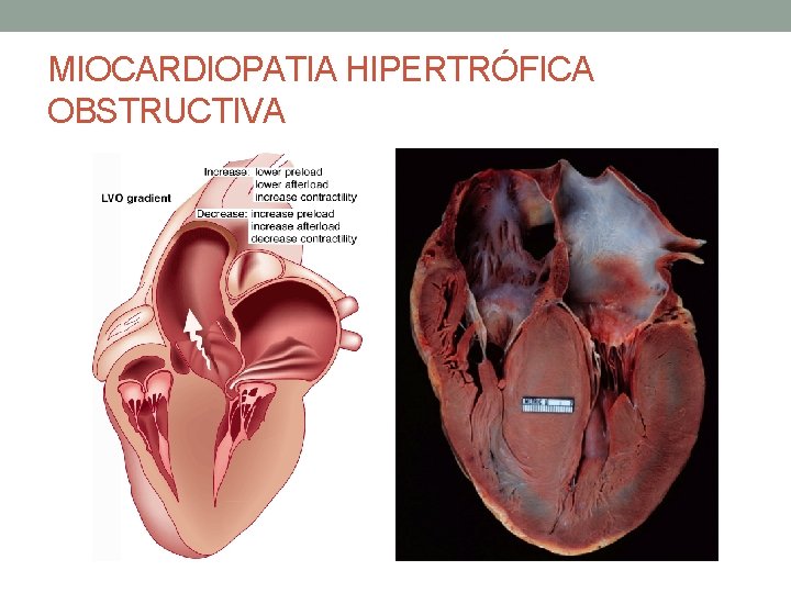 MIOCARDIOPATIA HIPERTRÓFICA OBSTRUCTIVA MIOCARDIOPATIA HIPERTRÓFICA OBSTRUCTIVA