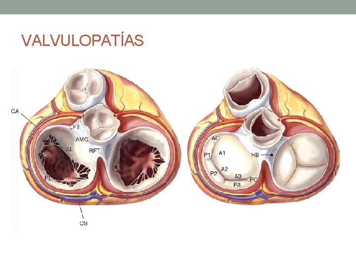 VALVULOPATÍAS VALVULOPATÍAS