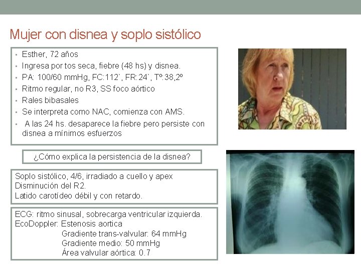 Mujer con disnea y soplo sistólico • Esther, 72 años • Ingresa por tos Mujer con disnea y soplo sistólico • Esther, 72 años • Ingresa por tos