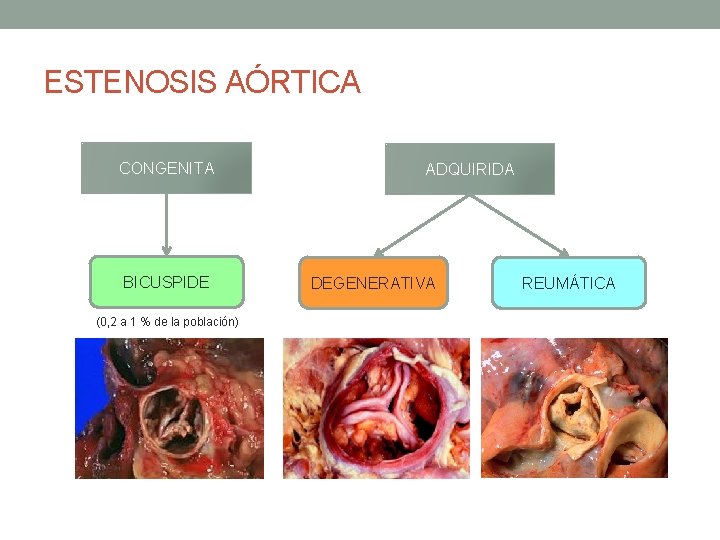 ESTENOSIS AÓRTICA CONGENITA BICUSPIDE (0, 2 a 1 % de la población) ADQUIRIDA DEGENERATIVA ESTENOSIS AÓRTICA CONGENITA BICUSPIDE (0, 2 a 1 % de la población) ADQUIRIDA DEGENERATIVA