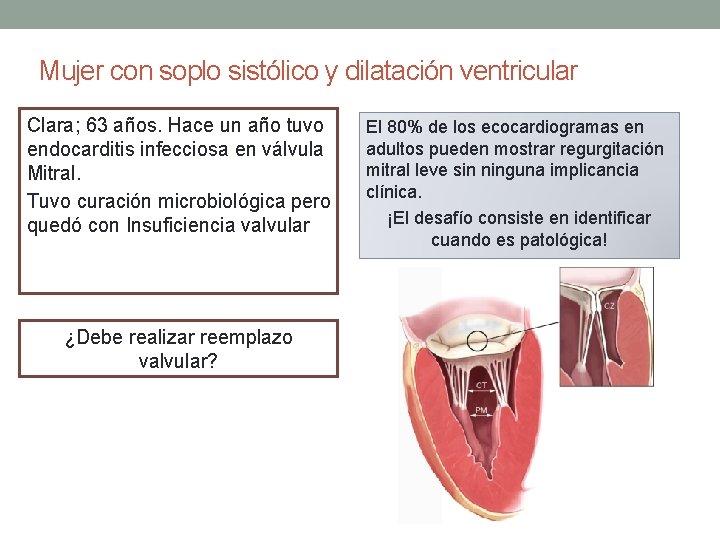 Mujer con soplo sistólico y dilatación ventricular Clara; 63 años. Hace un año tuvo Mujer con soplo sistólico y dilatación ventricular Clara; 63 años. Hace un año tuvo