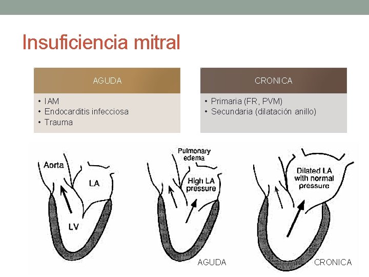 Insuficiencia mitral AGUDA • IAM • Endocarditis infecciosa • Trauma CRONICA • Primaria (FR, Insuficiencia mitral AGUDA • IAM • Endocarditis infecciosa • Trauma CRONICA • Primaria (FR,