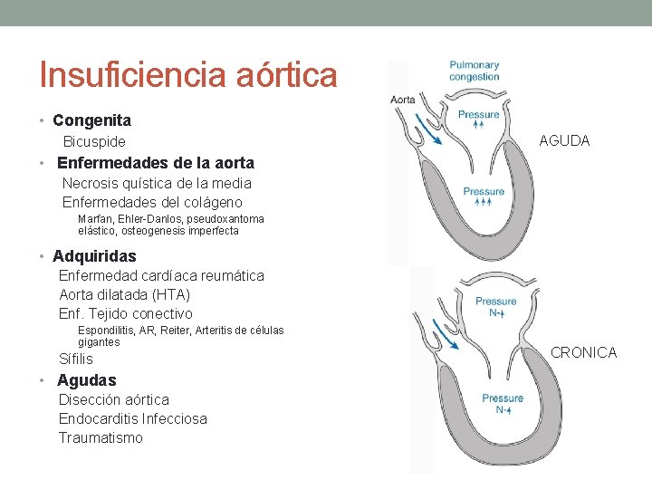 Insuficiencia aórtica • Congenita Bicuspide AGUDA • Enfermedades de la aorta Necrosis quística de Insuficiencia aórtica • Congenita Bicuspide AGUDA • Enfermedades de la aorta Necrosis quística de