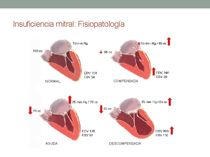 Insuficiencia mitral: Fisiopatología ≅ ≅ NORMAL AGUDA COMPENSADA DESCOMPENSADA Insuficiencia mitral: Fisiopatología ≅ ≅ NORMAL AGUDA COMPENSADA DESCOMPENSADA