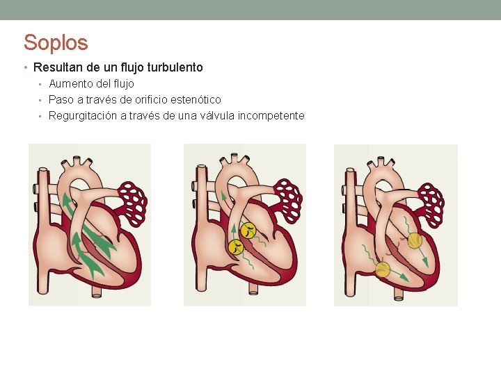 Soplos • Resultan de un flujo turbulento • Aumento del flujo • Paso a Soplos • Resultan de un flujo turbulento • Aumento del flujo • Paso a