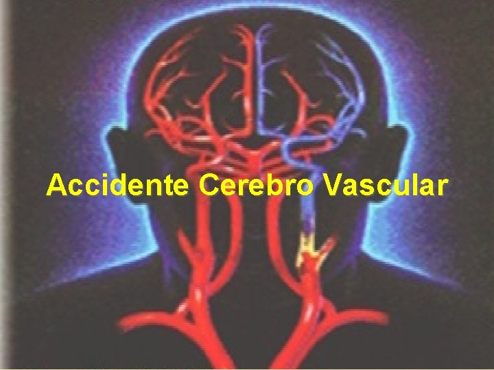 Accidente Cerebro Vascular 