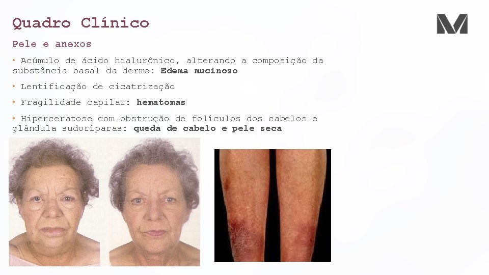 Quadro Clínico Pele e anexos • Acúmulo de ácido hialurônico, alterando a composição da Quadro Clínico Pele e anexos • Acúmulo de ácido hialurônico, alterando a composição da