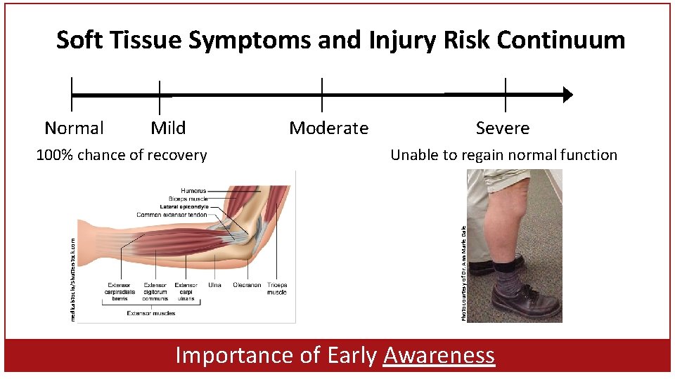 Soft Tissue Symptoms and Injury Risk Continuum Normal Mild Moderate Severe Unable to regain