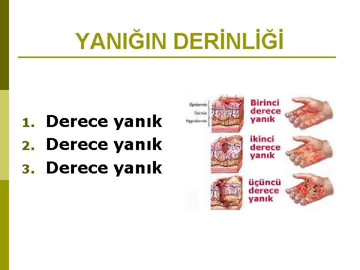 YANIĞIN DERİNLİĞİ 1. 2. 3. Derece yanık 