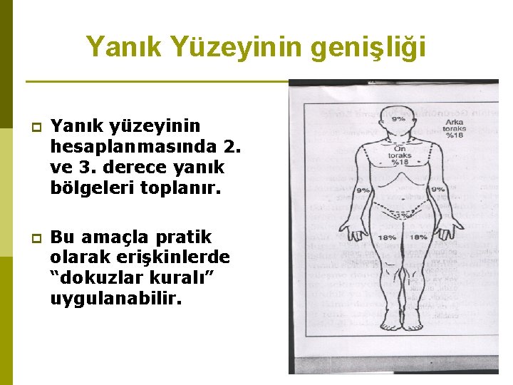 Yanık Yüzeyinin genişliği p Yanık yüzeyinin hesaplanmasında 2. ve 3. derece yanık bölgeleri toplanır.