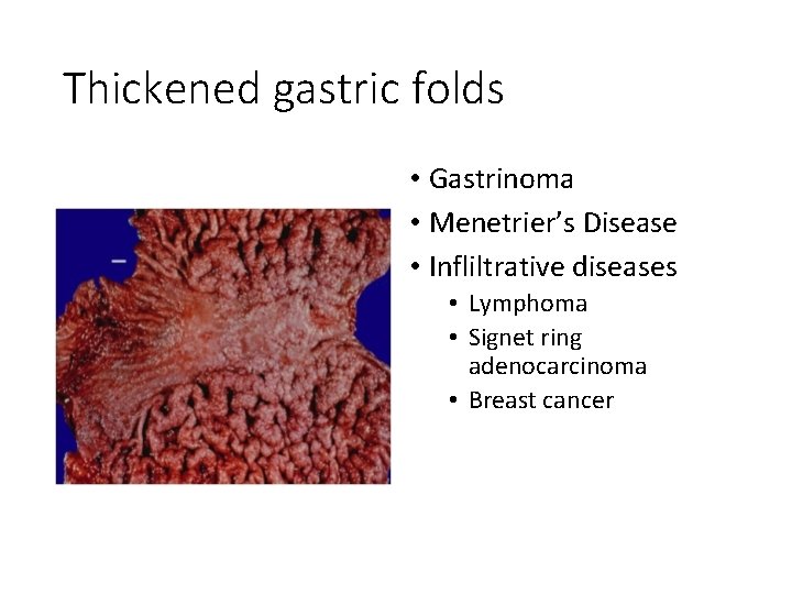 Thickened gastric folds • Gastrinoma • Menetrier’s Disease • Infliltrative diseases • Lymphoma •