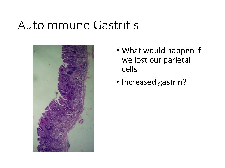 Autoimmune Gastritis • What would happen if we lost our parietal cells • Increased