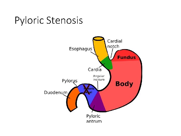 Pyloric Stenosis X 