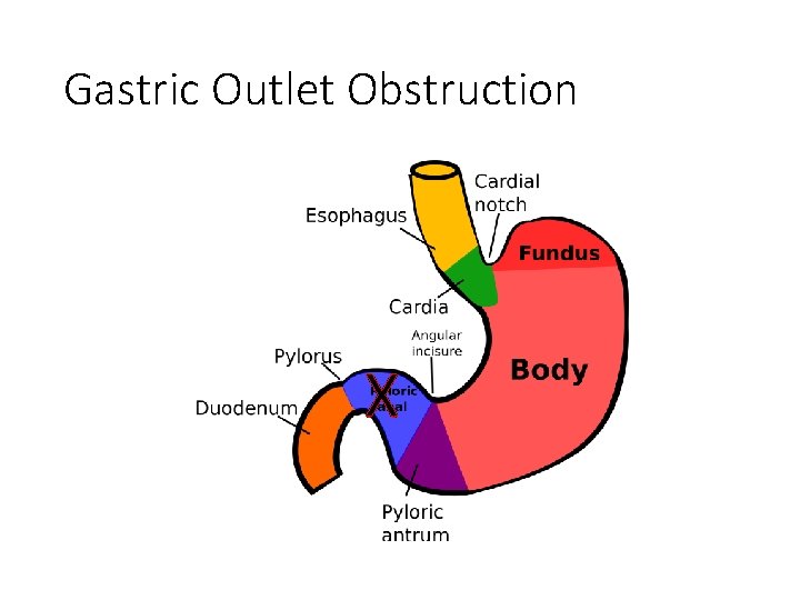 Gastric Outlet Obstruction X 
