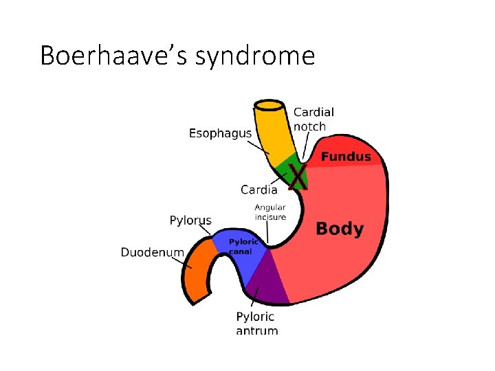 Boerhaave’s syndrome X 