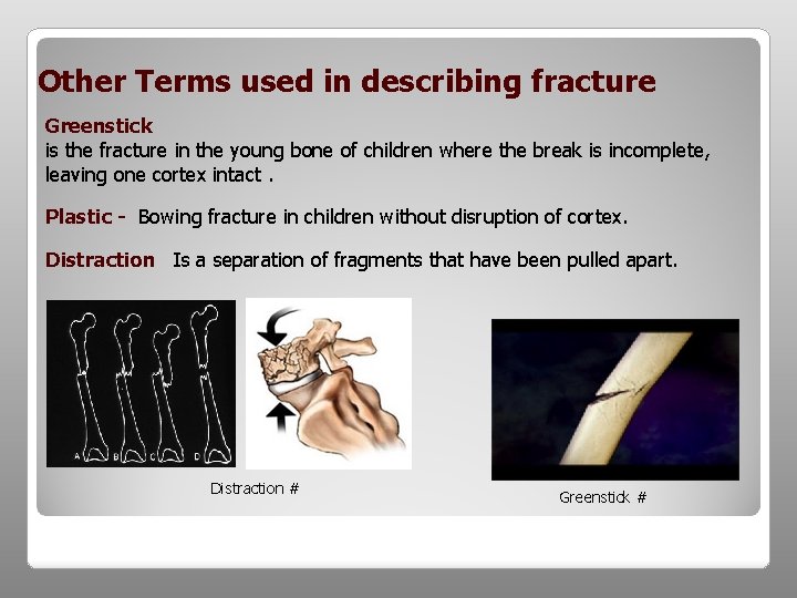 Other Terms used in describing fracture Greenstick is the fracture in the young bone