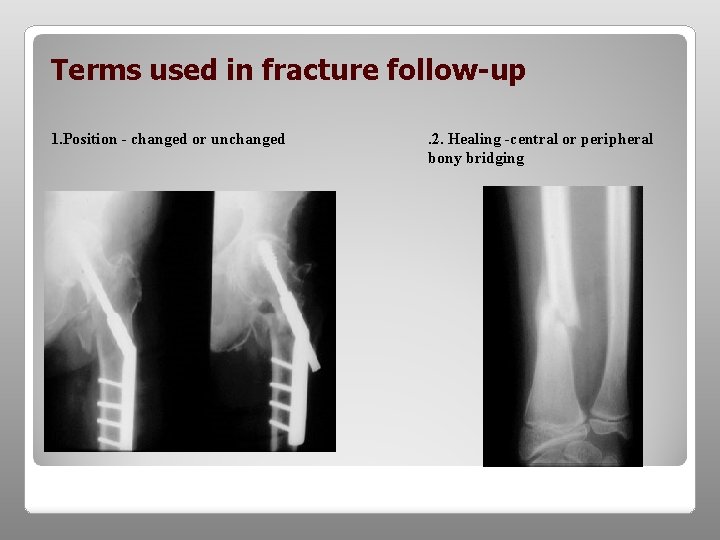 Terms used in fracture follow-up 1. Position - changed or unchanged . 2. Healing