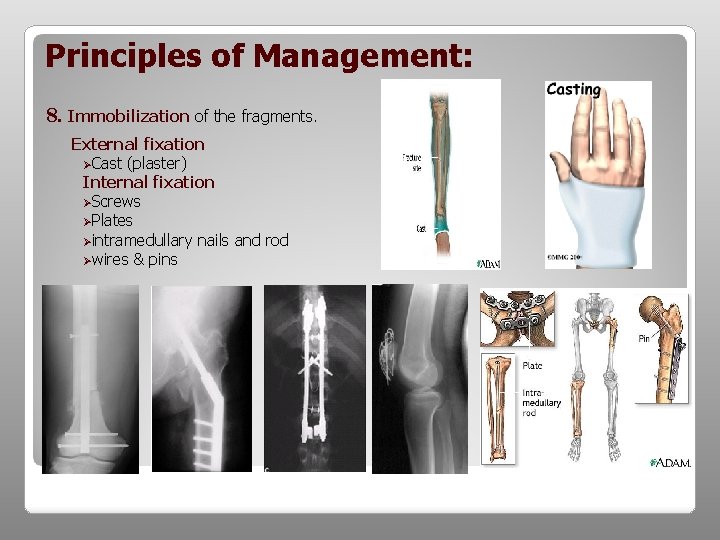 Principles of Management: 8. Immobilization of the fragments. External fixation ØCast (plaster) Internal fixation