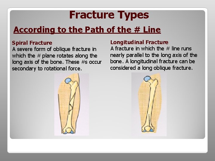 Fracture Types According to the Path of the # Line Spiral Fracture A severe